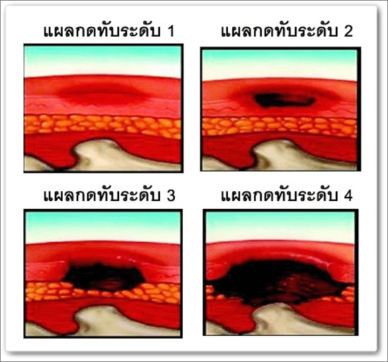 ตำรายาใส่แผลกดทับ(แผลเน่า)